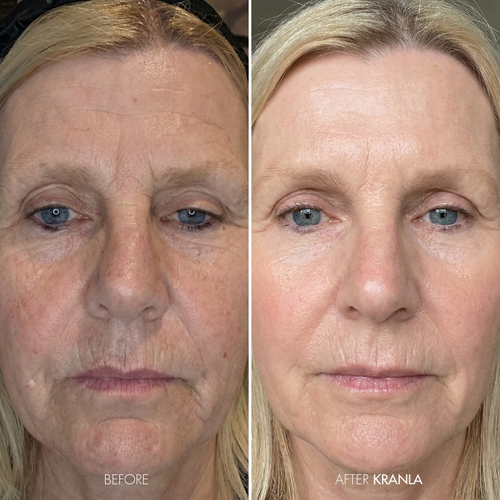 Barbara W. – Age 61