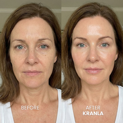 Micro Needling Infusion Kit