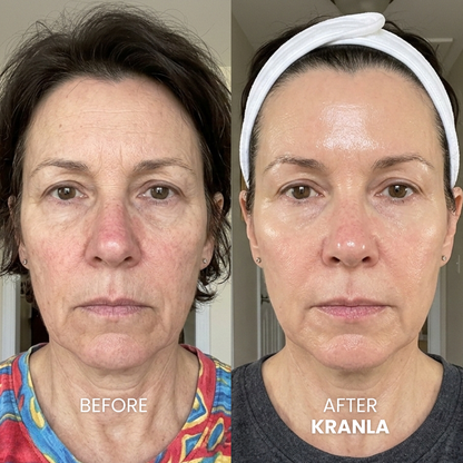 Micro Needling Infusion Kit